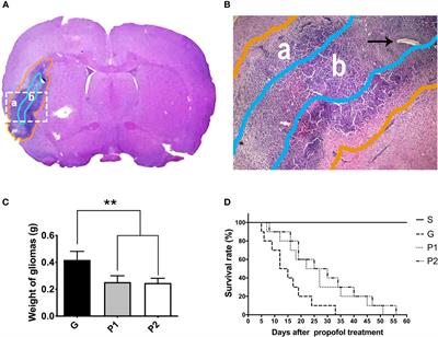 Antioxidant Effect of Propofol in Gliomas and Its Association With Divalent Metal Transporter 1